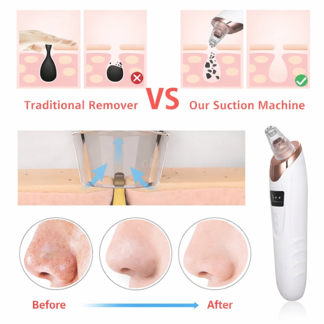 Electric Face Vacuum Blackhead Remover & Pore Cleaner